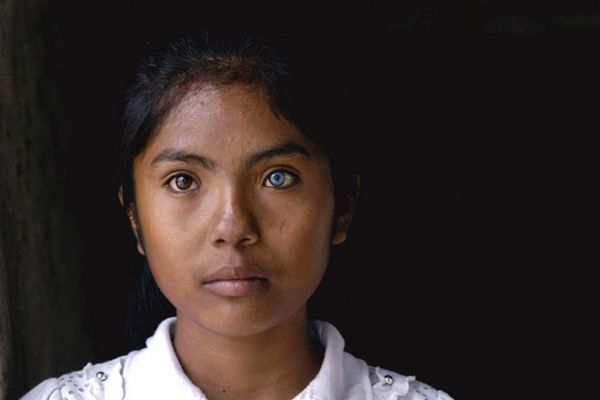 Cô gái có đôi mắt hai màu kỳ lạ ở Ninh Thuận 4