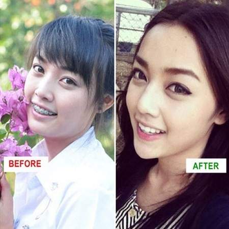 Hot girl Thái Lan đổi đời nhờ phẫu thuật thẩm mỹ 3