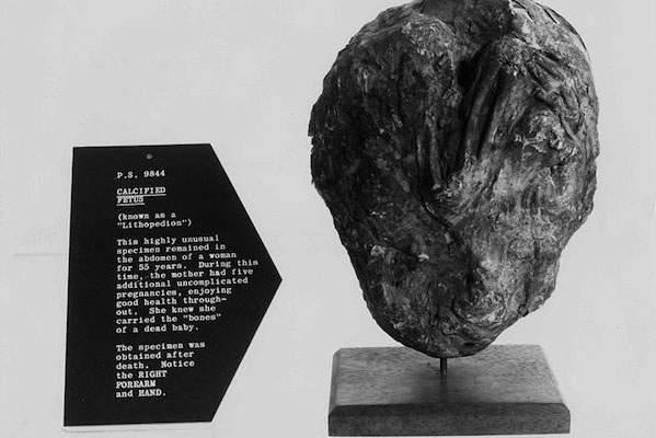 Tử cung hóa đá 200 tuổi nặng 3kg ở Anh 3