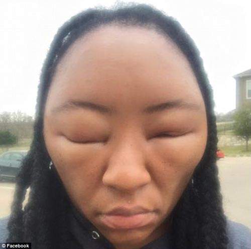 Cô gái biến dạng khuôn mặt vì dị ứng thuốc nhuộm tóc 9