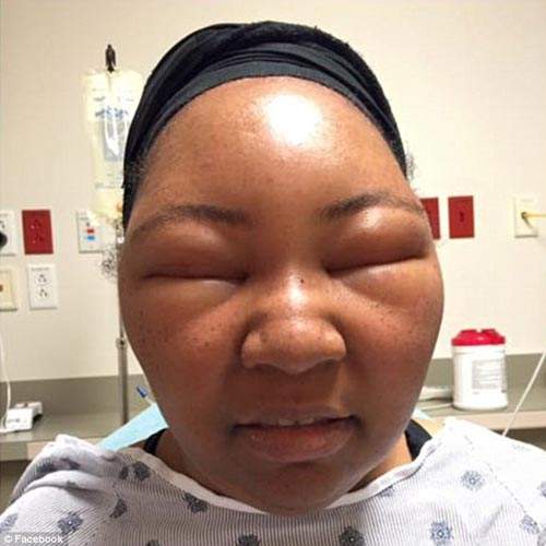 Cô gái biến dạng khuôn mặt vì dị ứng thuốc nhuộm tóc 3