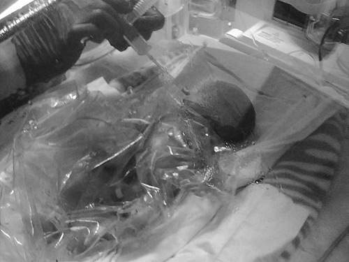 Kỳ diệu bé sinh non 0,8kg sống sót nhờ… chiếc túi nhựa 3