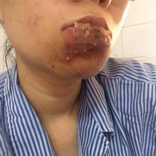 Xót xa cô gái Quảng Ninh phải cắt bỏ môi sau khi tiêm chất làm đầy 9