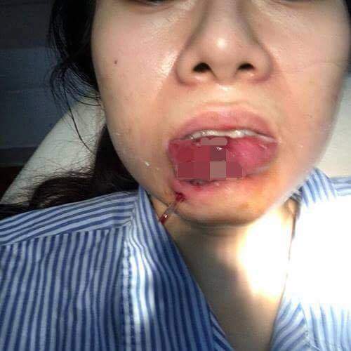 Xót xa cô gái Quảng Ninh phải cắt bỏ môi sau khi tiêm chất làm đầy 3