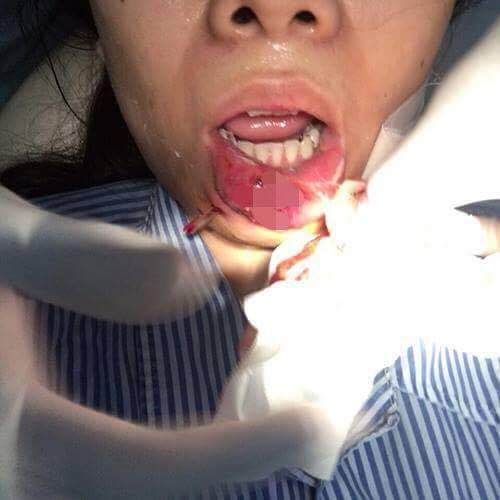 Xót xa cô gái Quảng Ninh phải cắt bỏ môi sau khi tiêm chất làm đầy 6