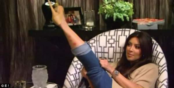 Kim Kardashian đau đớn, da xấu vì mắc bệnh vảy nến 3