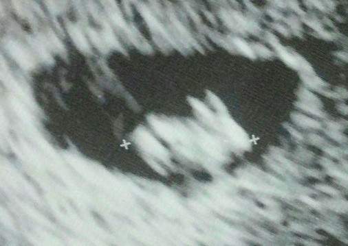Mẹ bầu 7 tuần siêu âm thấy “thỏ con” trong bụng 3