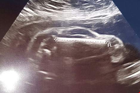 Mẹ bầu 7 tuần siêu âm thấy “thỏ con” trong bụng 4