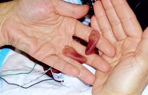 Mẹ phá thai, bé 22 tuần vẫn sống sót nhưng không được ai chào đón 9