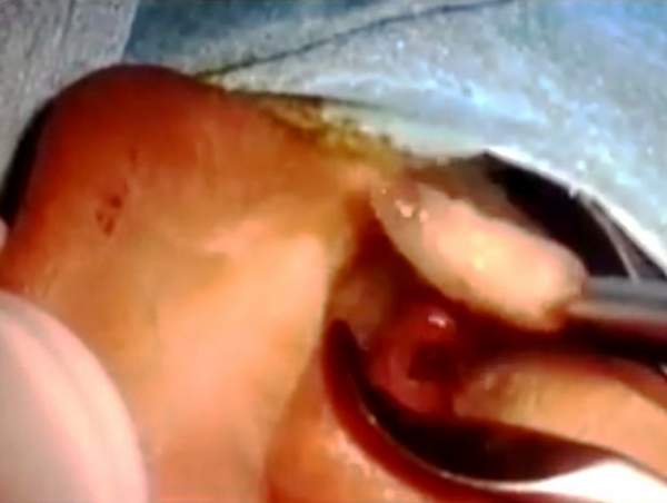 Bác sĩ kinh hoàng gắp ra 14 con dòi trong tai bệnh nhân 2