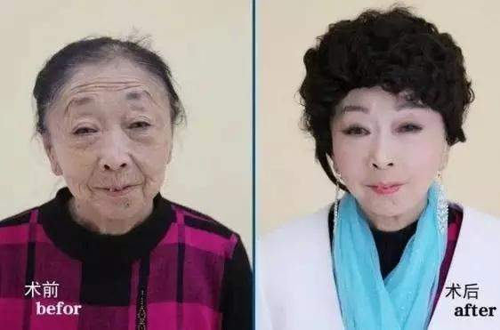 Cụ bà 71 tuổi quyết phẫu thuật thẩm mỹ để đẹp đôi với người tình 32 tuổi 27