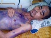 Diễn viên Nguyễn Hoàng lại phải nhập viện vì chân bị "hóa thạch" 9