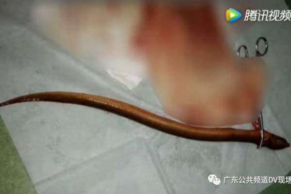 Lươn dài 50cm chui từ hậu môn vào làm tổ trong bụng người đàn ông 2