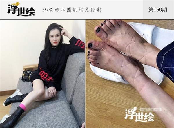 Sao Hoa ngữ người nhập viện, kẻ ngồi xe lăn vì giày cao gót 21
