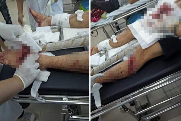 Bênh vợ bị đánh, chồng bị nhóm “giang hồ” chém nhập viện