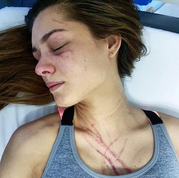 Hỗn chiến hoa hậu Venezuela bị nữ ca sĩ đánh trọng thương