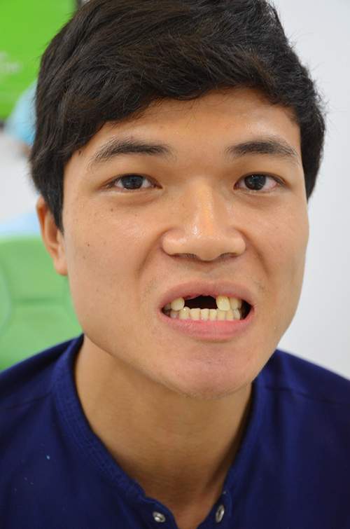 Chàng trai Thái Bình thoát kiếp mất răng sau ca cấy ghép ly kỳ 2