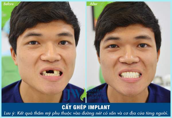 Chàng trai Thái Bình thoát kiếp mất răng sau ca cấy ghép ly kỳ 4