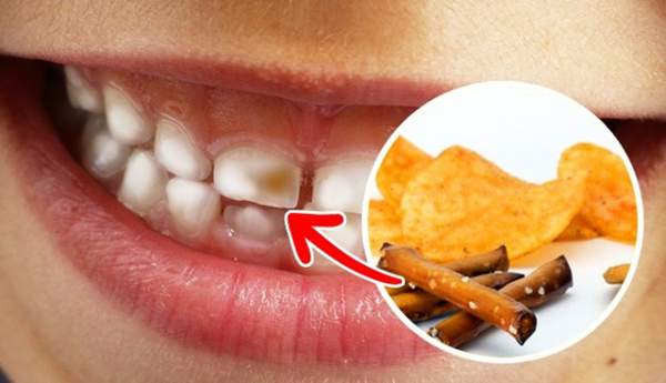 9 loại thực phẩm hay ăn hằng ngày có hại cho răng ít người biết 4