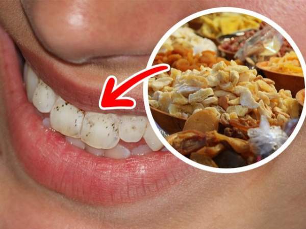 9 loại thực phẩm hay ăn hằng ngày có hại cho răng ít người biết 7