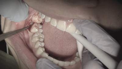 Ám ảnh về biến chứng khi nhổ răng khôn – lựa chọn nào là an toàn?