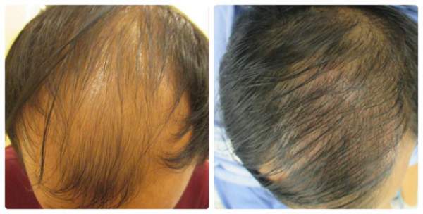 Cấy tóc sinh học Bio Fibre - giải pháp ưu việt cho người hói đầu 2