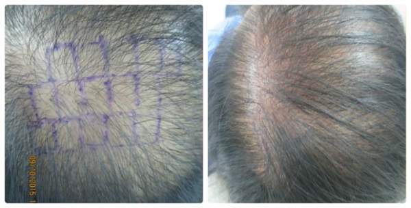Cấy tóc sinh học Bio Fibre - giải pháp ưu việt cho người hói đầu 3