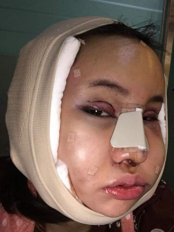 Cô gái Thái "đập mặt xây lại" chịu đau đớn hàng tháng trời 2
