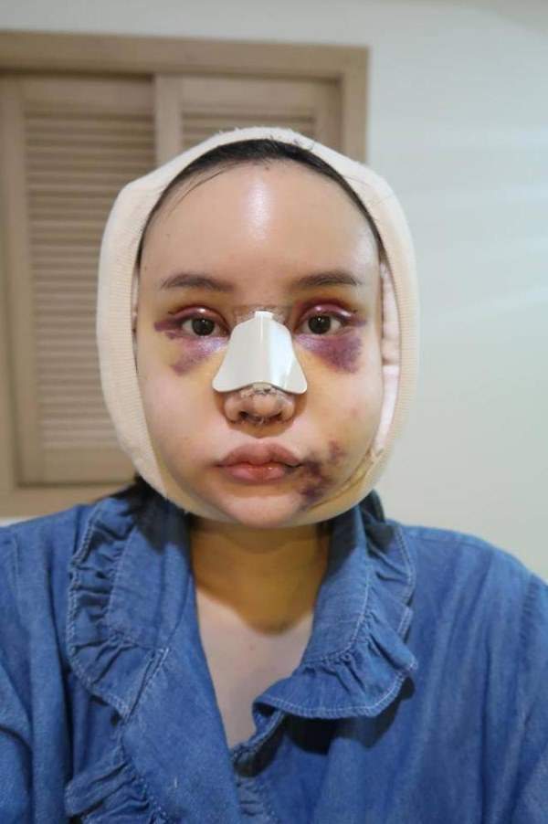 Cô gái Thái "đập mặt xây lại" chịu đau đớn hàng tháng trời 3