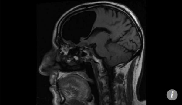 Nhập viện vì đau đầu, kinh ngạc thấy trong não có khoảng trống lớn 2