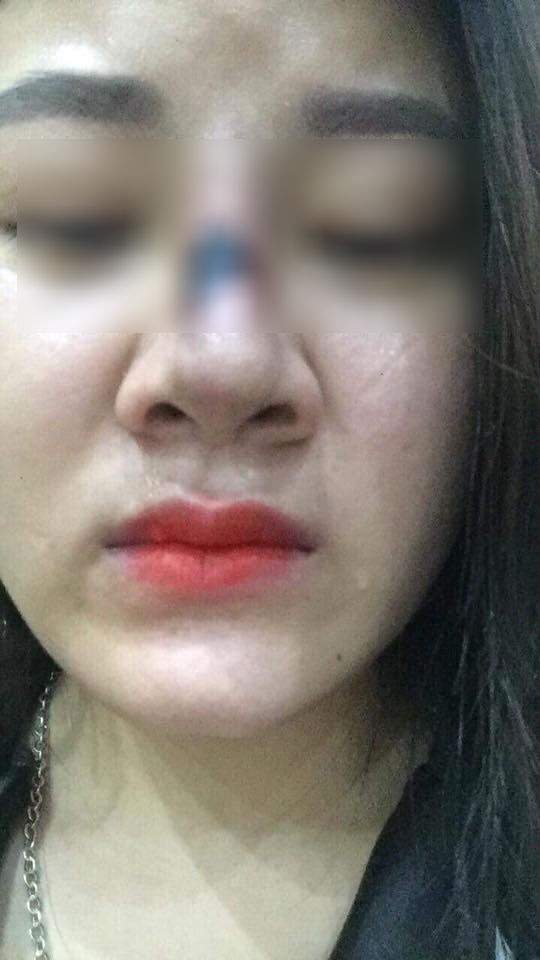 Dân mạng khiếp vía vụ cô gái Sài Gòn có mũi sưng đen vì tiêm chất làm đầy 3