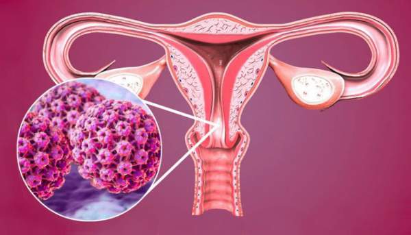 Những dấu hiệu đầu tiên của bệnh ung thư cổ tử cung 3