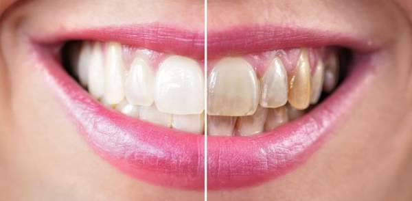 Vì sao răng bị ố vàng? 3