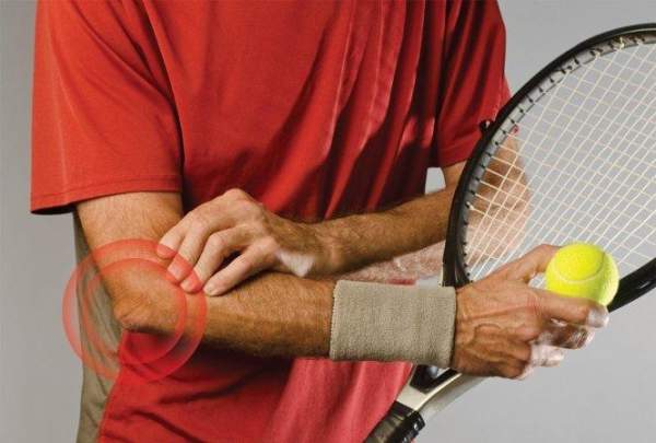 Hội chứng tennis elbow là gì?