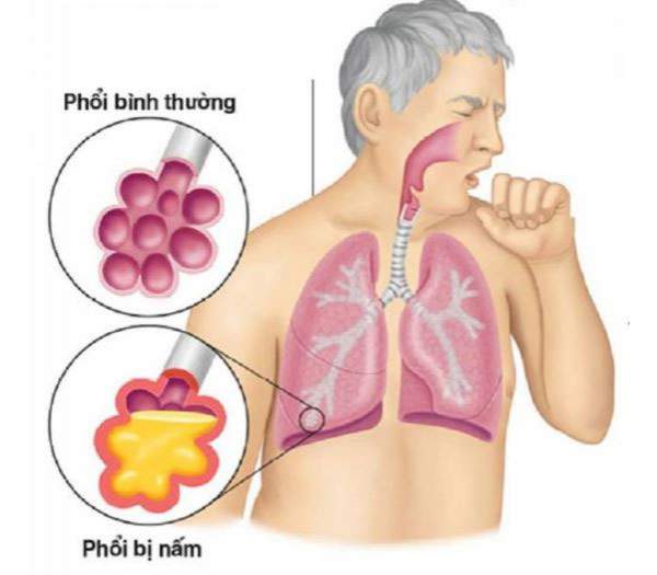 Bệnh nấm phổi là gì?