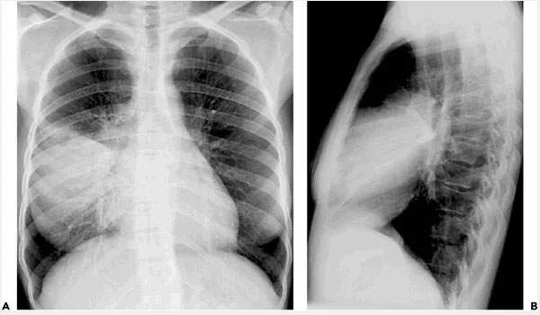 Viêm phổi do Mycoplasma: Nguyên nhân,triệu chứng và cách điều trị 3