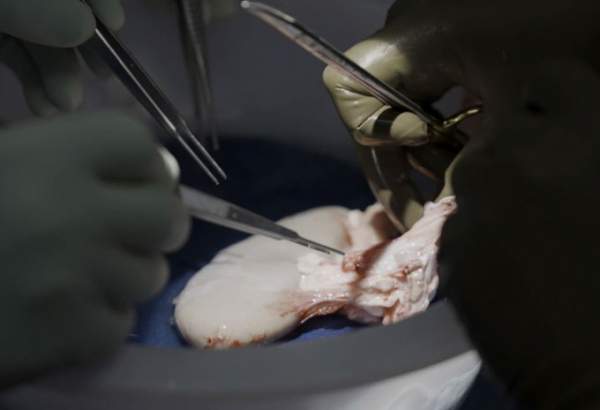 Cấy ghép thành công thận lợn đột biến gene cho bệnh nhân chết não 2