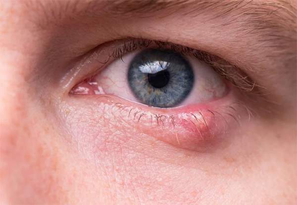 Top 10 nguyên nhân gây đỏ mắt và cách điều trị 6