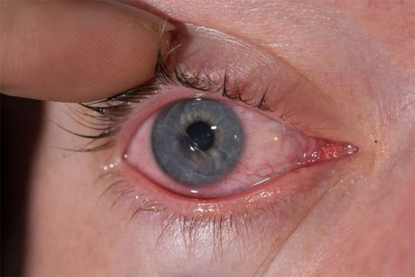 Top 10 nguyên nhân gây đỏ mắt và cách điều trị 3