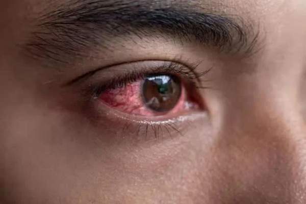 Top 10 nguyên nhân gây đỏ mắt và cách điều trị 5