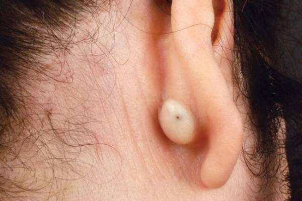 Nguyên nhân gây u cục sau tai? Khi nào cần thăm khám bác sĩ? 3