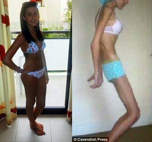 Ham giảm béo, một thiếu nữ thành "bộ xương" nặng 23kg 2