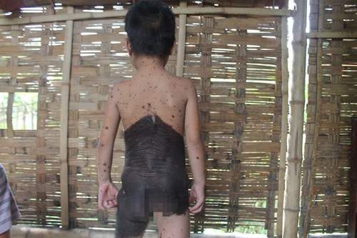 Xót xa bé gái 5 tuổi mọc lông như "người rừng" ở Nghệ An 2