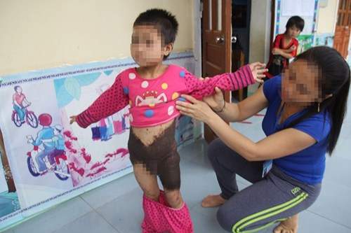 Xót xa bé gái 5 tuổi mọc lông như "người rừng" ở Nghệ An 3