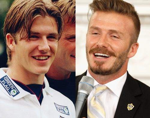Nhan sắc người nổi tiếng trước và sau khi sửa răng 9