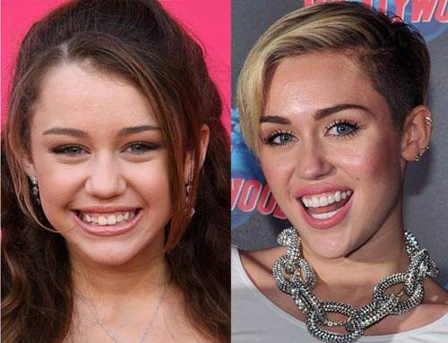 Nhan sắc người nổi tiếng trước và sau khi sửa răng 3