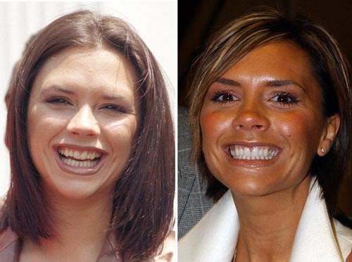 Nhan sắc người nổi tiếng trước và sau khi sửa răng 12
