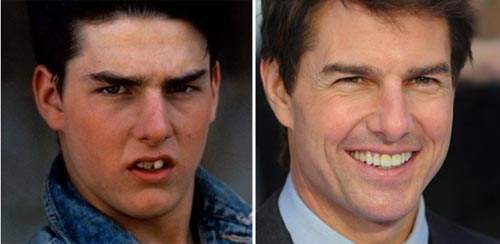 Nhan sắc người nổi tiếng trước và sau khi sửa răng 18