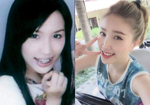 Nhan sắc người nổi tiếng trước và sau khi sửa răng 33