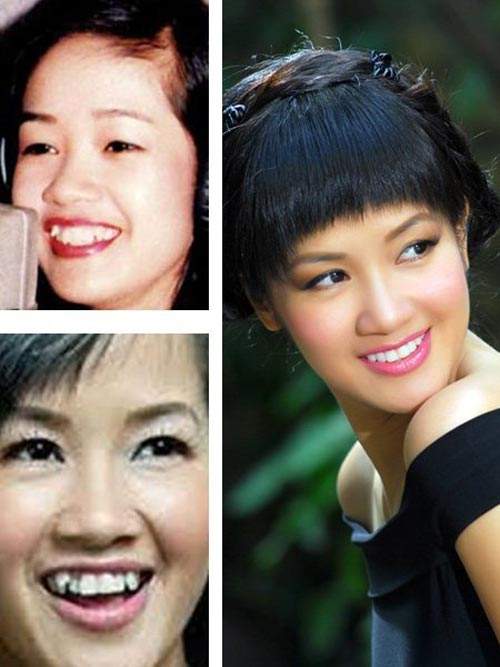 Nhan sắc người nổi tiếng trước và sau khi sửa răng 27